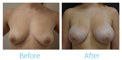 Breast Augmentation Before & After Gallery - Patient 58151780 - Image 1