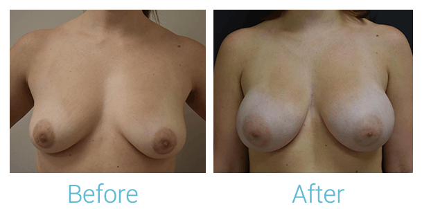 Breast Augmentation Before & After Gallery - Patient 58151780 - Image 1
