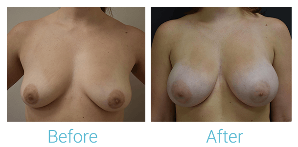 Breast Augmentation Gallery - Patient 58151780 - Image 1
