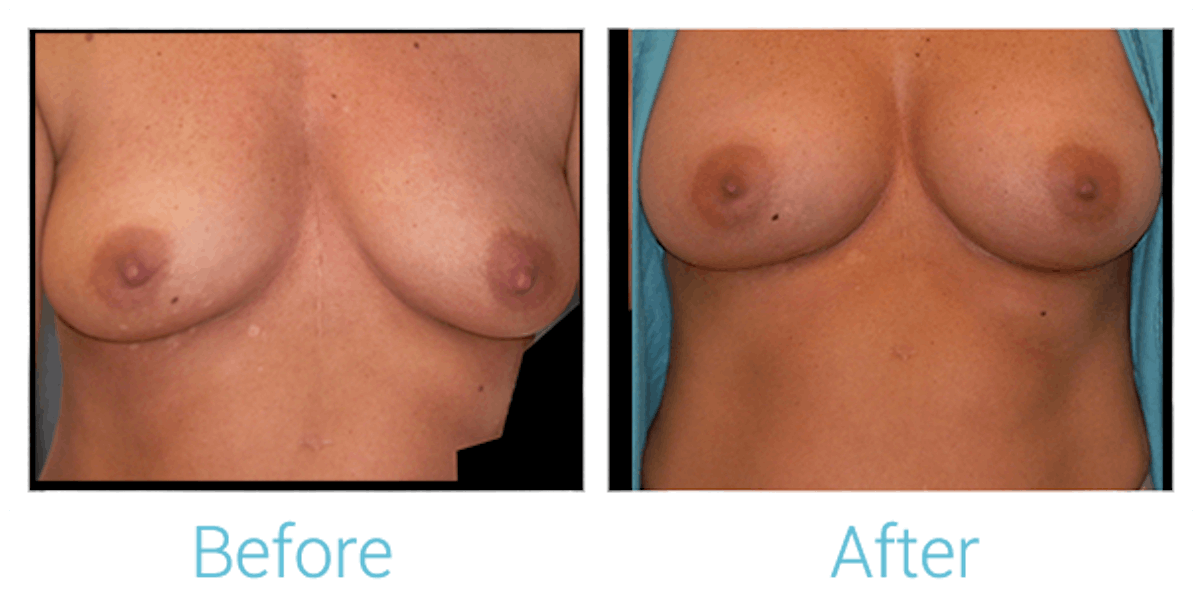 Breast Augmentation Before & After Gallery - Patient 58151781 - Image 1