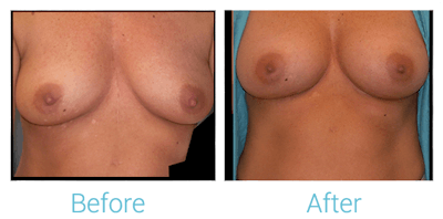 Breast Augmentation Gallery - Patient 58151781 - Image 1