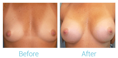 Breast Augmentation Gallery - Patient 58151782 - Image 1