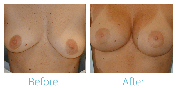 Breast Augmentation Before & After Gallery - Patient 58151783 - Image 1