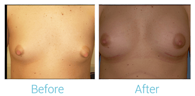 Breast Augmentation Before & After Gallery - Patient 58151784 - Image 1