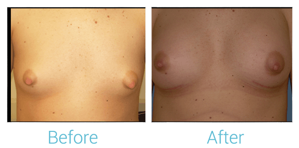 Breast Augmentation Gallery - Patient 58151784 - Image 1