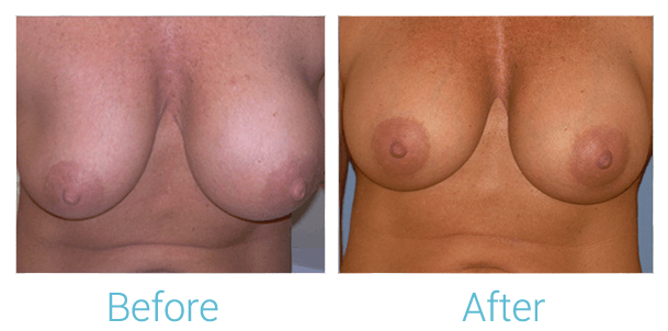 Breast Augmentation Before & After Gallery - Patient 58151785 - Image 1