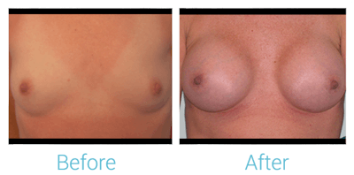 Breast Augmentation Before & After Gallery - Patient 58151786 - Image 1