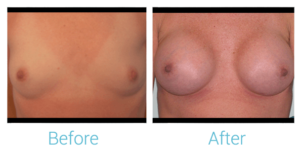 Breast Augmentation Before & After Gallery - Patient 58151786 - Image 1
