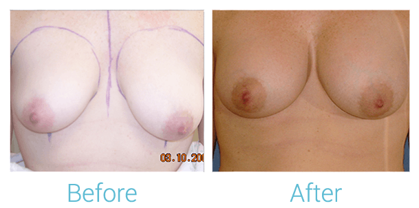 Breast Augmentation Before & After Gallery - Patient 58151787 - Image 1