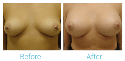 Breast Augmentation Before & After Gallery - Patient 58151793 - Image 1