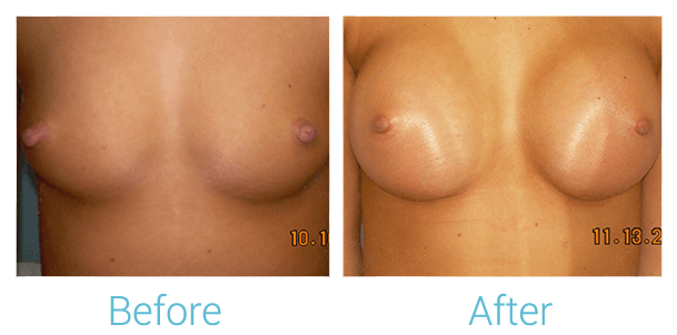 Breast Augmentation Before & After Gallery - Patient 58151794 - Image 1