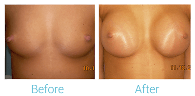 Breast Augmentation Before & After Gallery - Patient 58151794 - Image 1