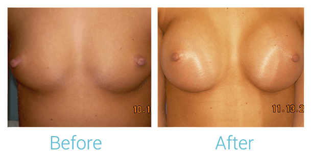 Breast Augmentation Gallery - Patient 58151794 - Image 1
