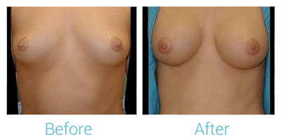 Breast Augmentation Before & After Gallery - Patient 58151795 - Image 1
