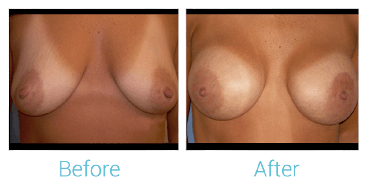 Breast Augmentation Before & After Gallery - Patient 58151796 - Image 1