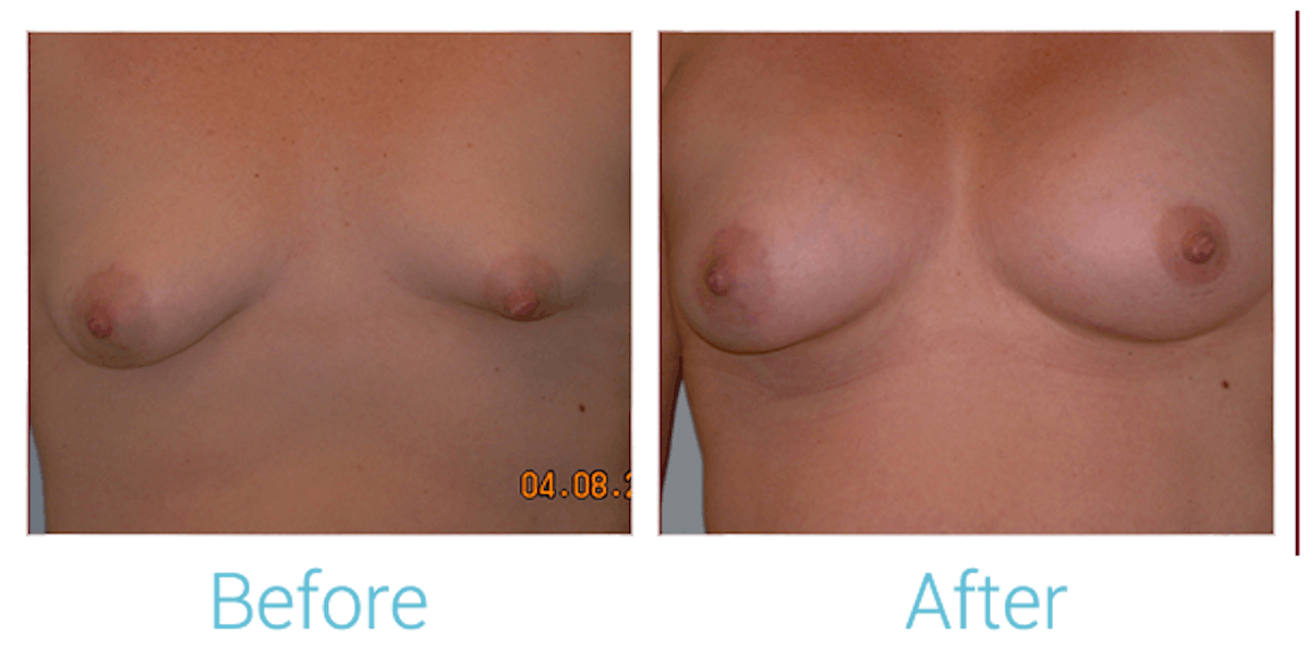 Breast Augmentation Before & After Gallery - Patient 58151797 - Image 1