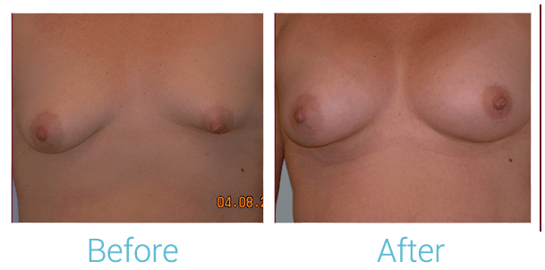 Breast Augmentation Before & After Gallery - Patient 58151797 - Image 1