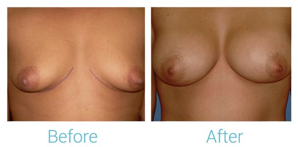 Breast Augmentation Before & After Gallery - Patient 58151798 - Image 1