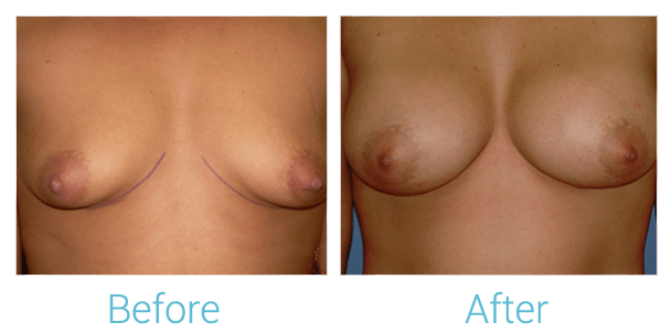 Breast Augmentation Gallery - Patient 58151798 - Image 1