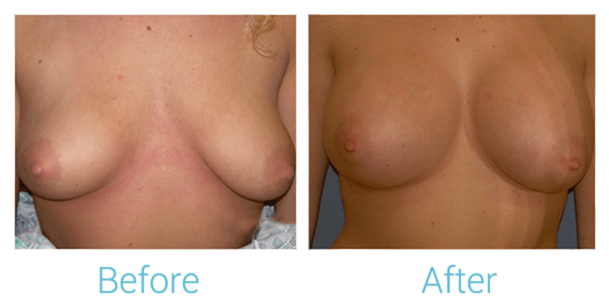Breast Augmentation Before & After Gallery - Patient 58151801 - Image 1