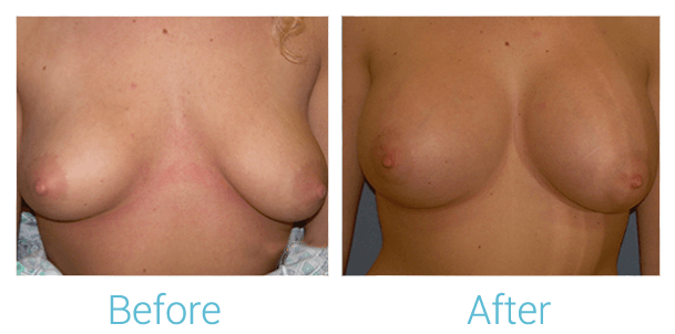 Breast Augmentation Gallery - Patient 58151801 - Image 1