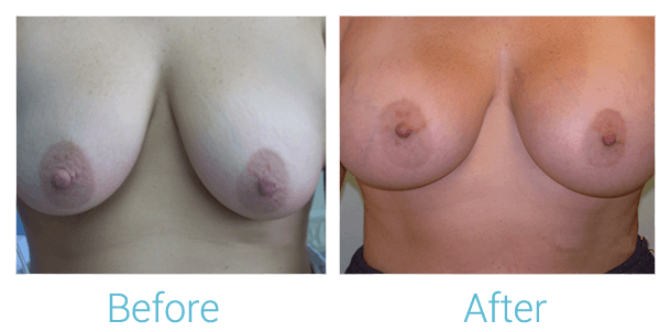 Breast Augmentation Gallery - Patient 58151810 - Image 1