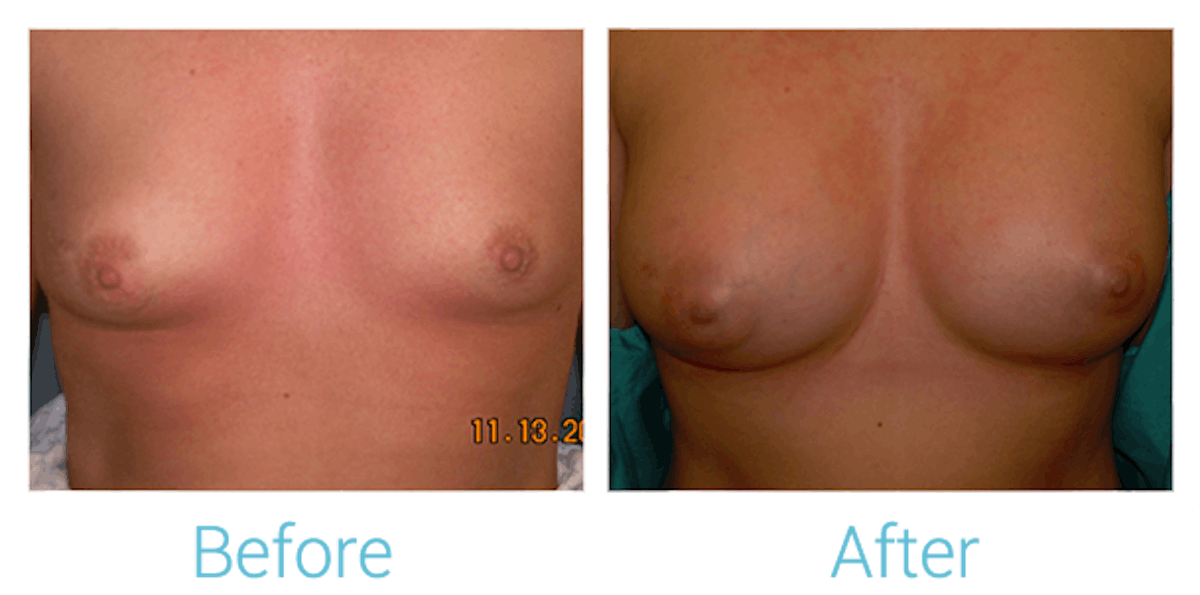 Breast Augmentation Before & After Gallery - Patient 58151811 - Image 1