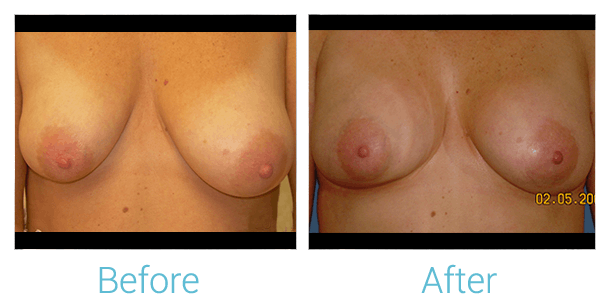 Breast Augmentation Gallery - Patient 58151812 - Image 1