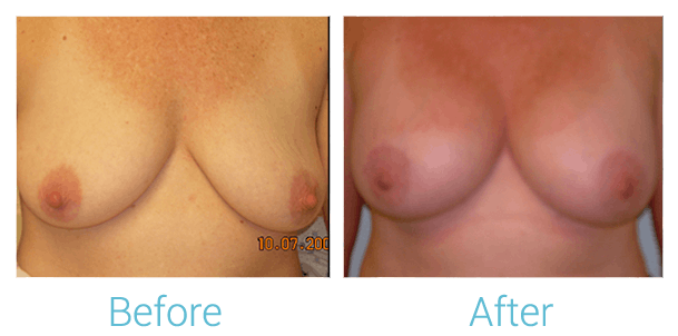 Breast Augmentation Before & After Gallery - Patient 58151814 - Image 1