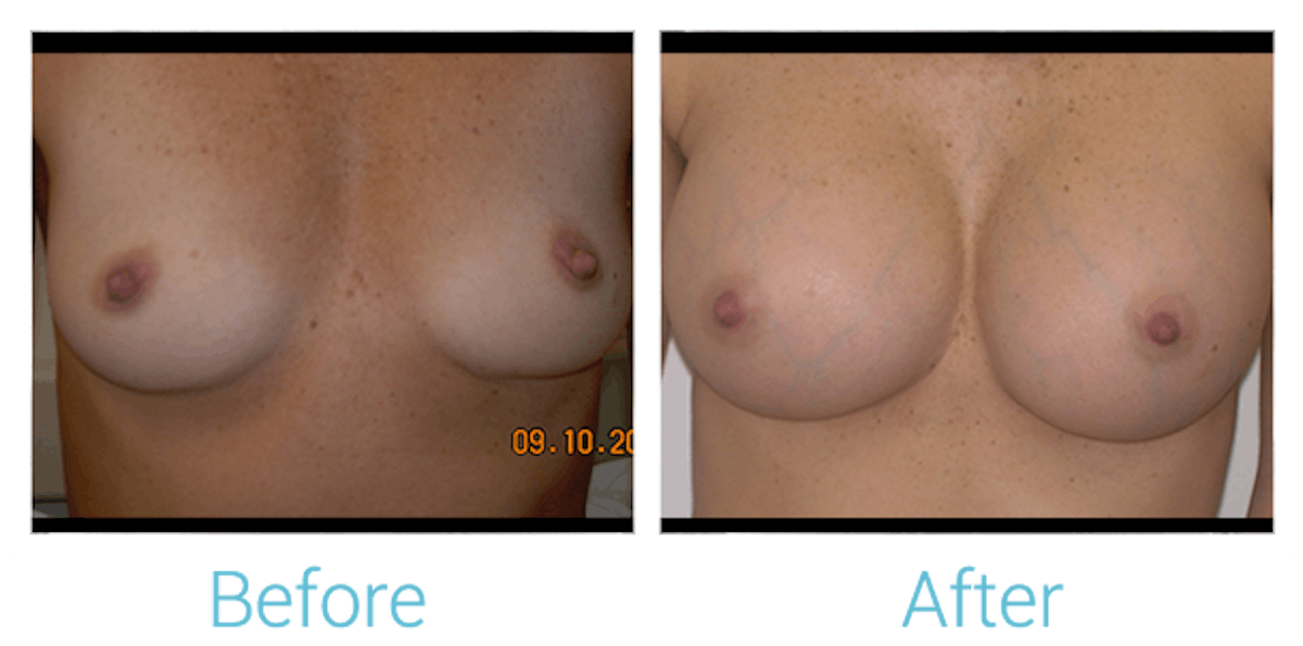 Breast Augmentation Before & After Gallery - Patient 58151815 - Image 1