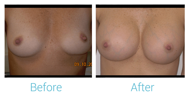 Breast Augmentation Before & After Gallery - Patient 58151815 - Image 1