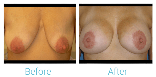 Breast Augmentation Before & After Gallery - Patient 58151820 - Image 1