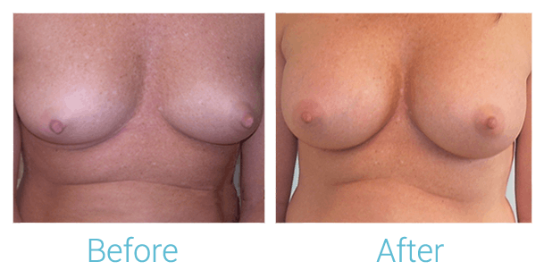 Breast Augmentation Before & After Gallery - Patient 58151840 - Image 1
