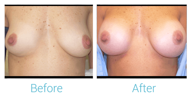 Breast Augmentation Before & After Gallery - Patient 58151841 - Image 1