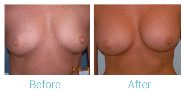 Breast Augmentation Before & After Gallery - Patient 58151842 - Image 1
