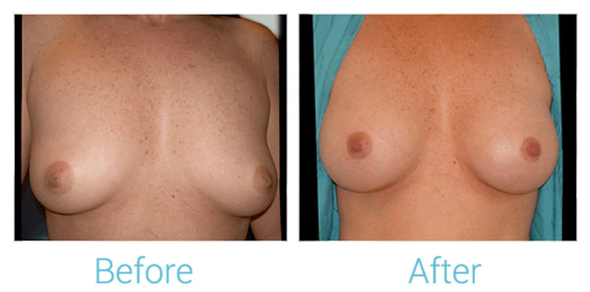 Breast Augmentation Before & After Gallery - Patient 58151843 - Image 1