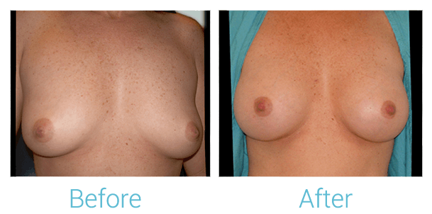 Breast Augmentation Gallery - Patient 58151843 - Image 1