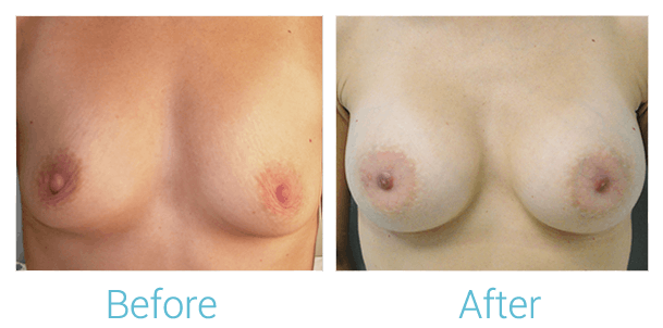 Breast Augmentation Before & After Gallery - Patient 58151844 - Image 1