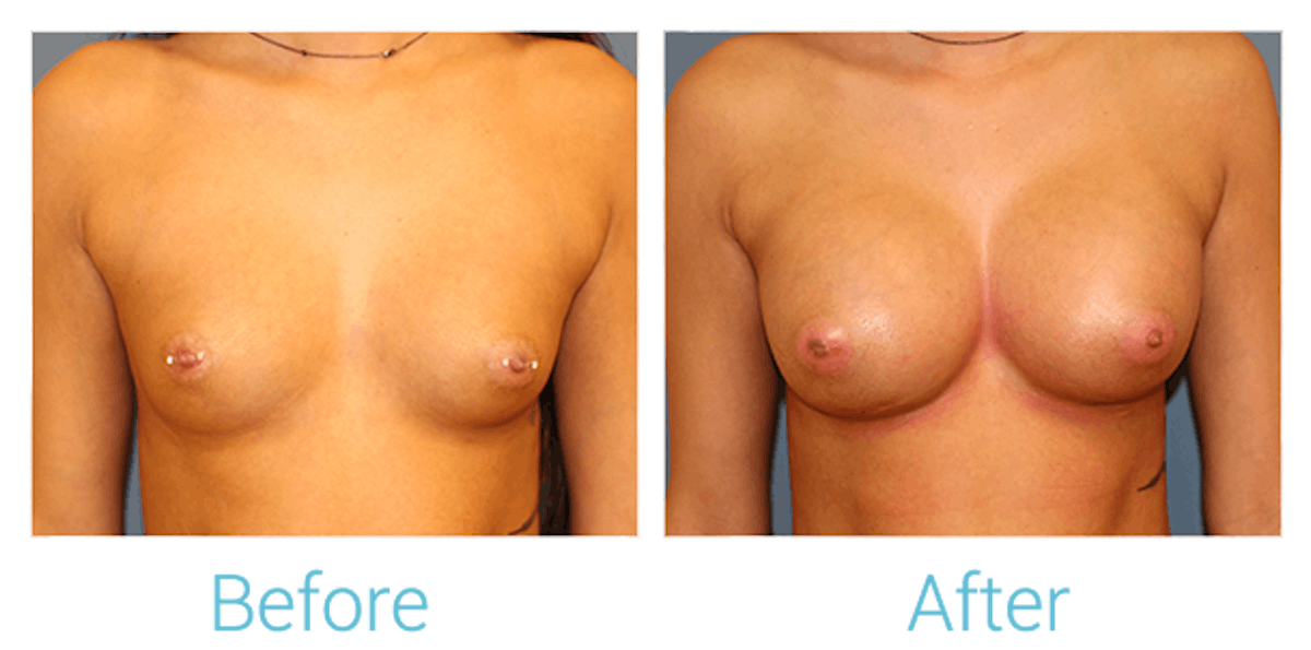 Breast Augmentation Before & After Gallery - Patient 58151845 - Image 1