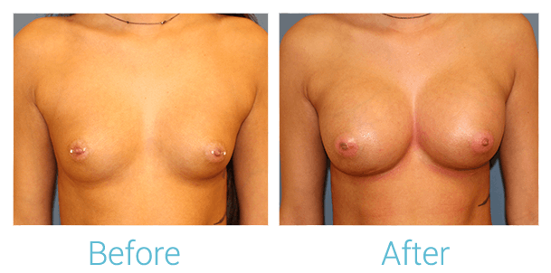 Breast Augmentation Gallery - Patient 58151845 - Image 1