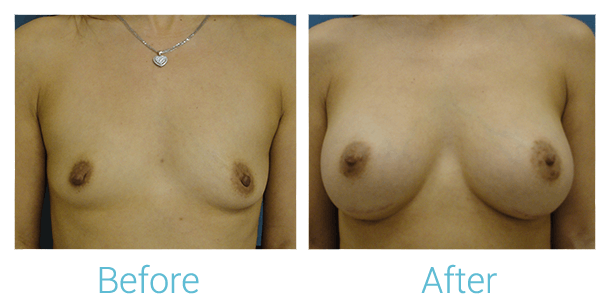 Breast Augmentation Before & After Gallery - Patient 58151846 - Image 1