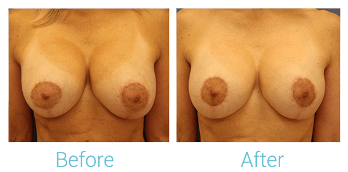 Breast Augmentation Before & After Gallery - Patient 58151847 - Image 1