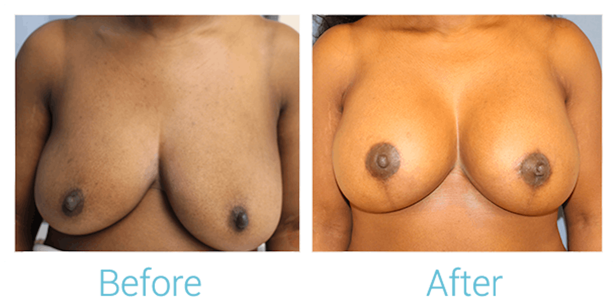 Breast Augmentation Before & After Gallery - Patient 58151848 - Image 1