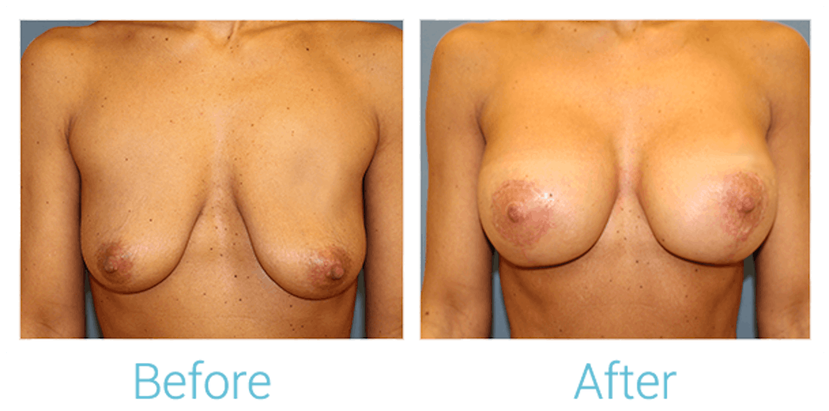 Breast Augmentation Before & After Gallery - Patient 58151849 - Image 1