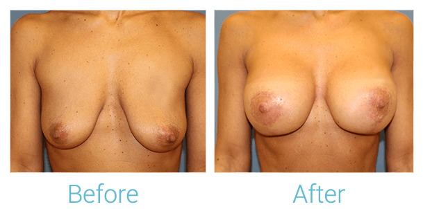 Breast Augmentation Before & After Gallery - Patient 58151849 - Image 1