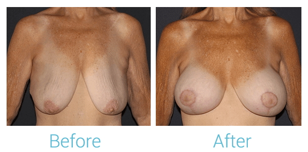 Breast Augmentation Before & After Gallery - Patient 58151850 - Image 1