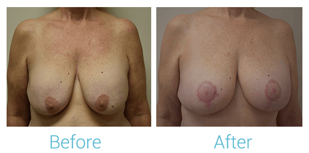Breast Augmentation Before & After Gallery - Patient 58151851 - Image 1