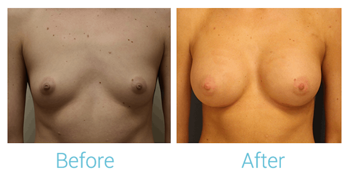 Breast Augmentation Before & After Gallery - Patient 58151852 - Image 1