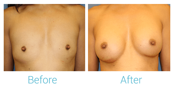 Breast Augmentation Before & After Gallery - Patient 58151853 - Image 1
