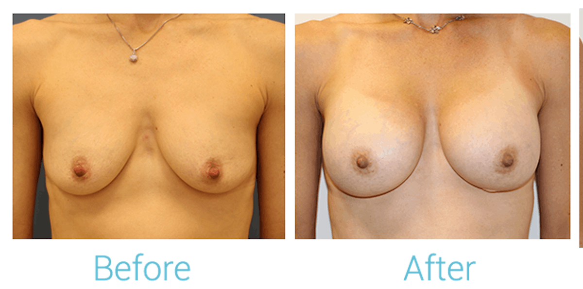 Breast Augmentation Before & After Gallery - Patient 58151854 - Image 1